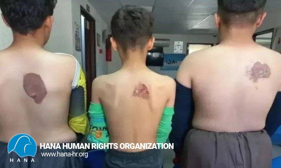 سوزاندن بدن سە کودک کار با اتو توسط کارافرما