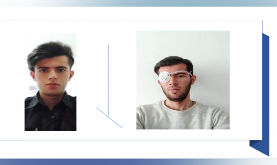 تصویر ارسالی از یک شهروند با هویت "آروین سلیمی" ٢٢ سالە اهل دهگلان، کە بر اثر گلولە ساچمەای بینایی چشم چپ خود را از دست داد.